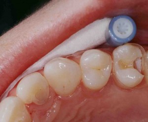 präparierter Zahn nach einer Karies
