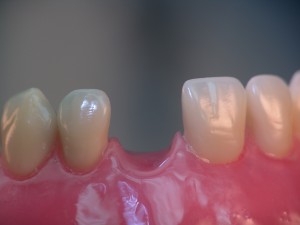 Zahnlücke gefüllt durch Implantate