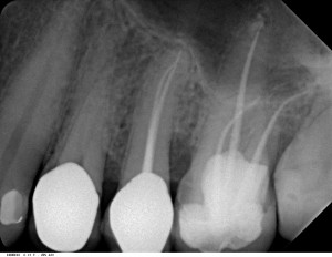 Rötgenbild zweier Zähne mit Wurzelkanalfüllungen