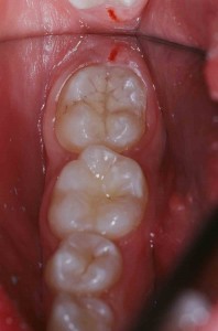 Zahn mit Fissuren