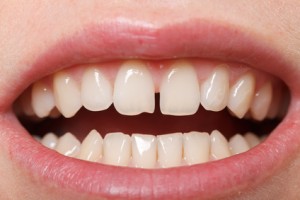 Diastema - Zahnlücke