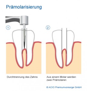 Praemolarisierung