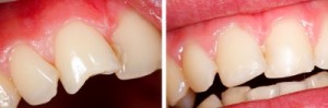 Zahnfraktur und Zustand nach der Behandlung